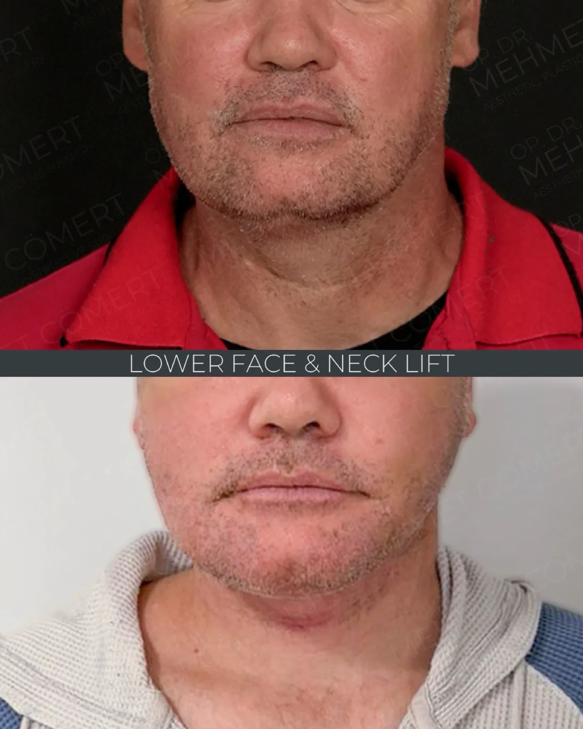 Deep Neck Lift, before and after