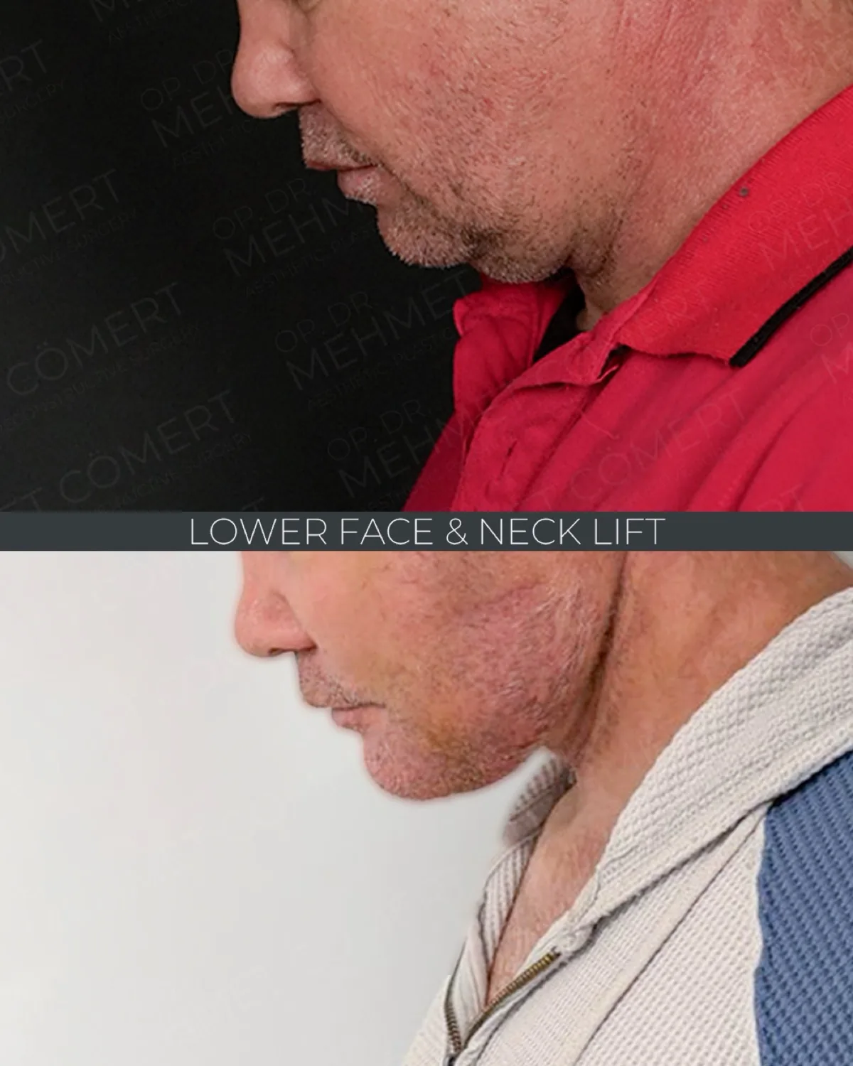 Profile before and after photographs of a male patient after a lower face and neck lift, showing a sharper angle between chin and neck.