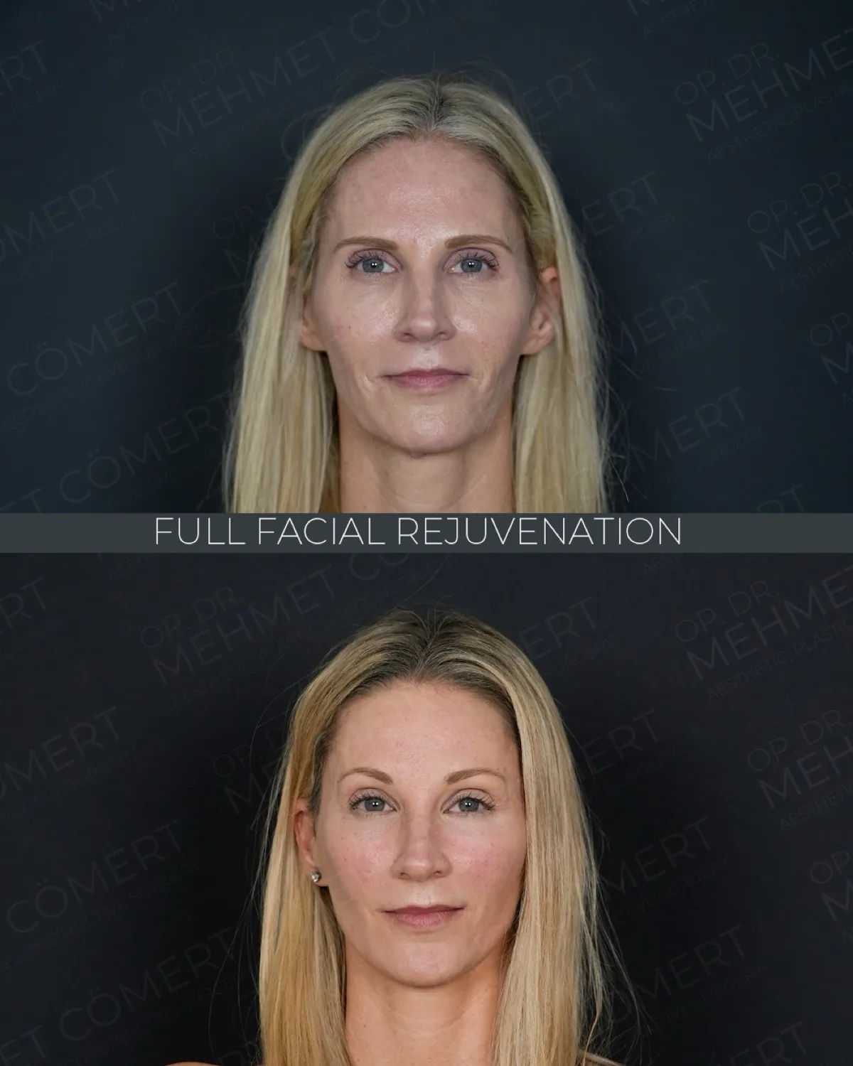 Facial Rejuvenation, before and after