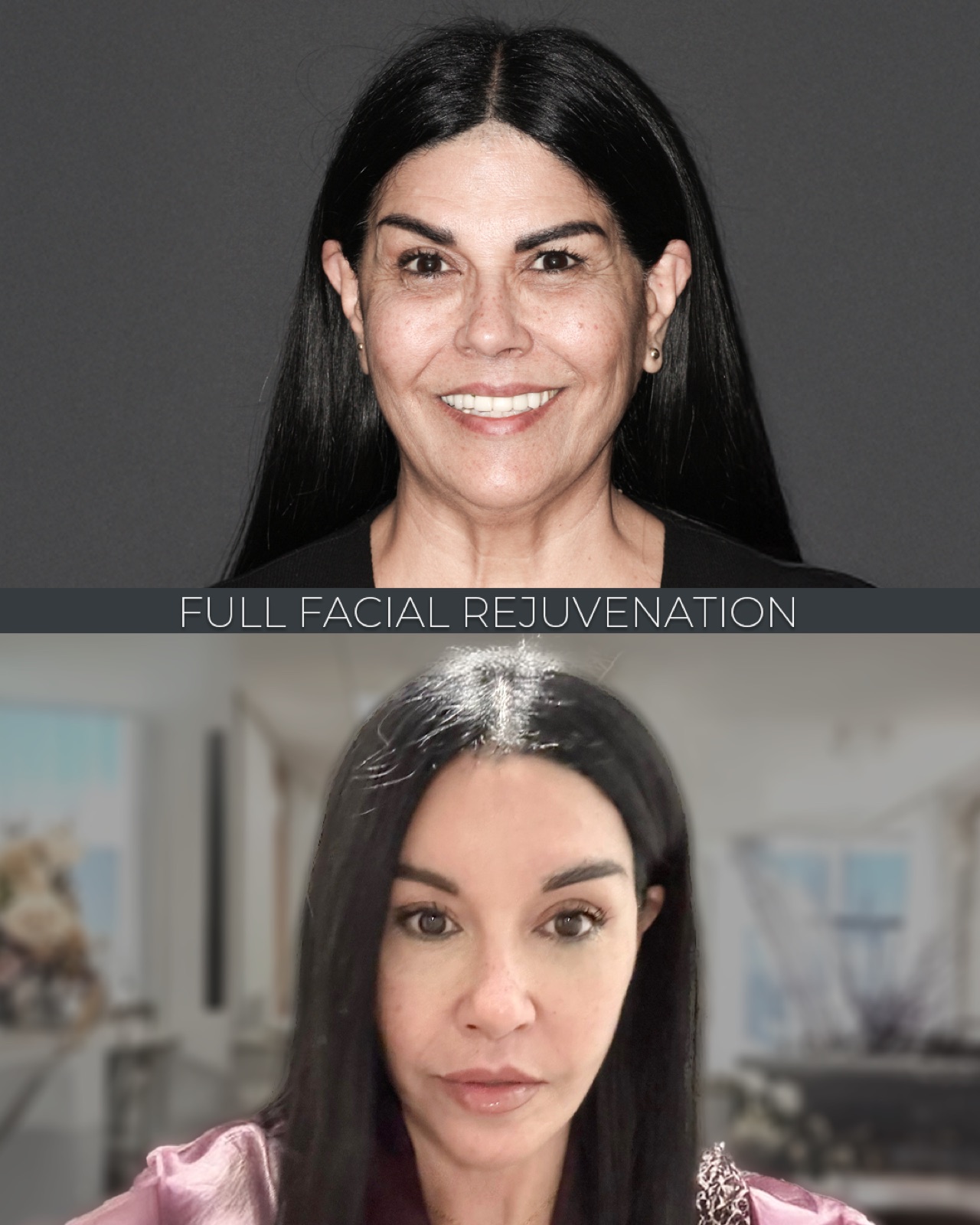 Revision Deep Plane Facelift — before and after
