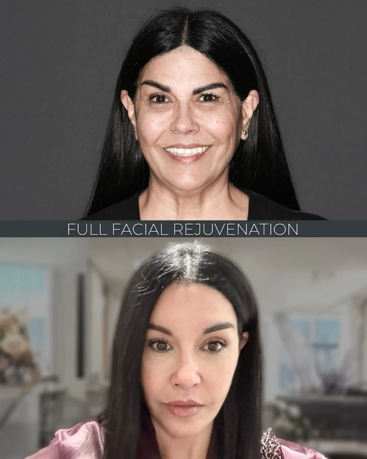 Revision Deep Plane Facelift, before and after