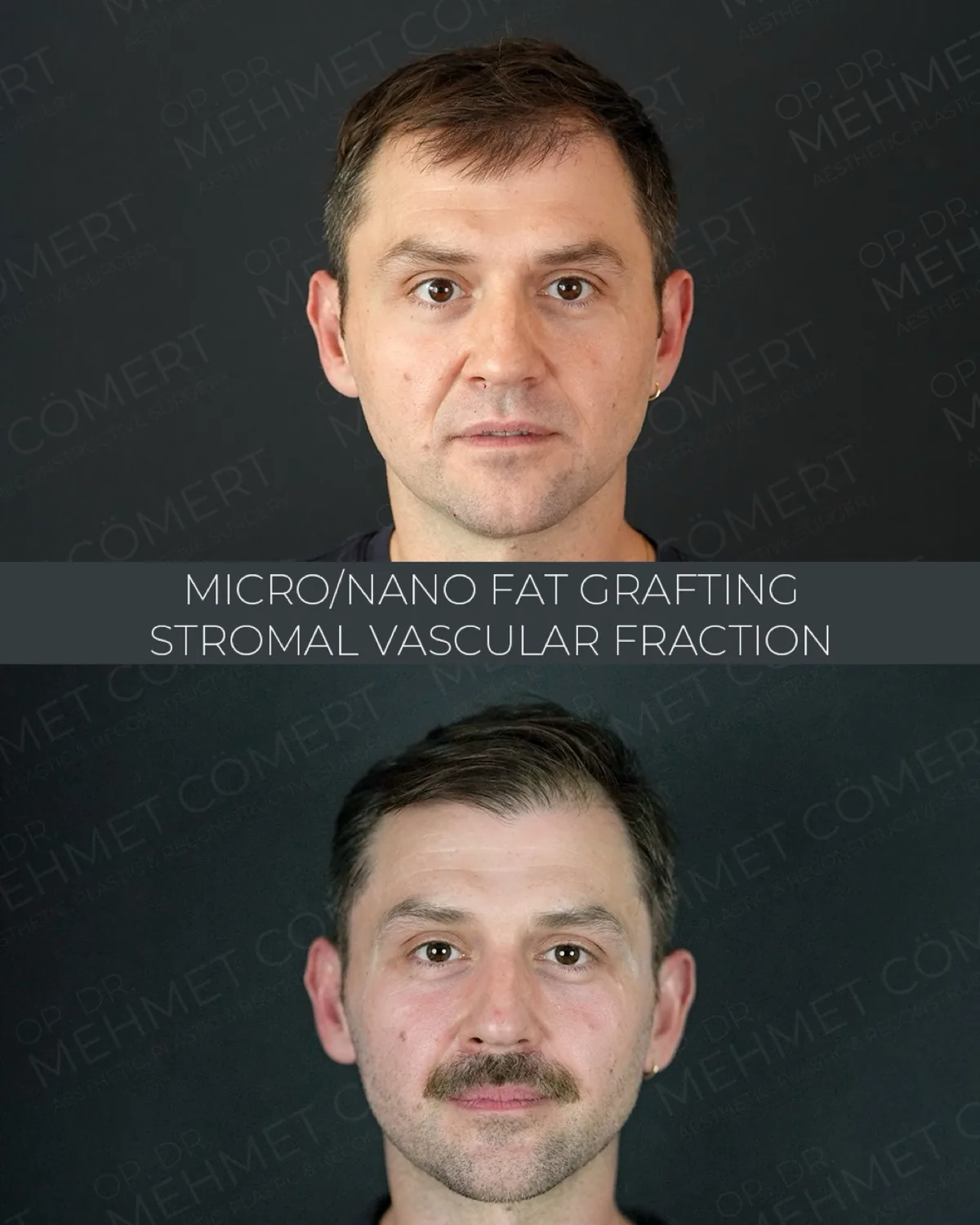 Fat, Nano-Fat & Micro-Fat Grafting, before and after