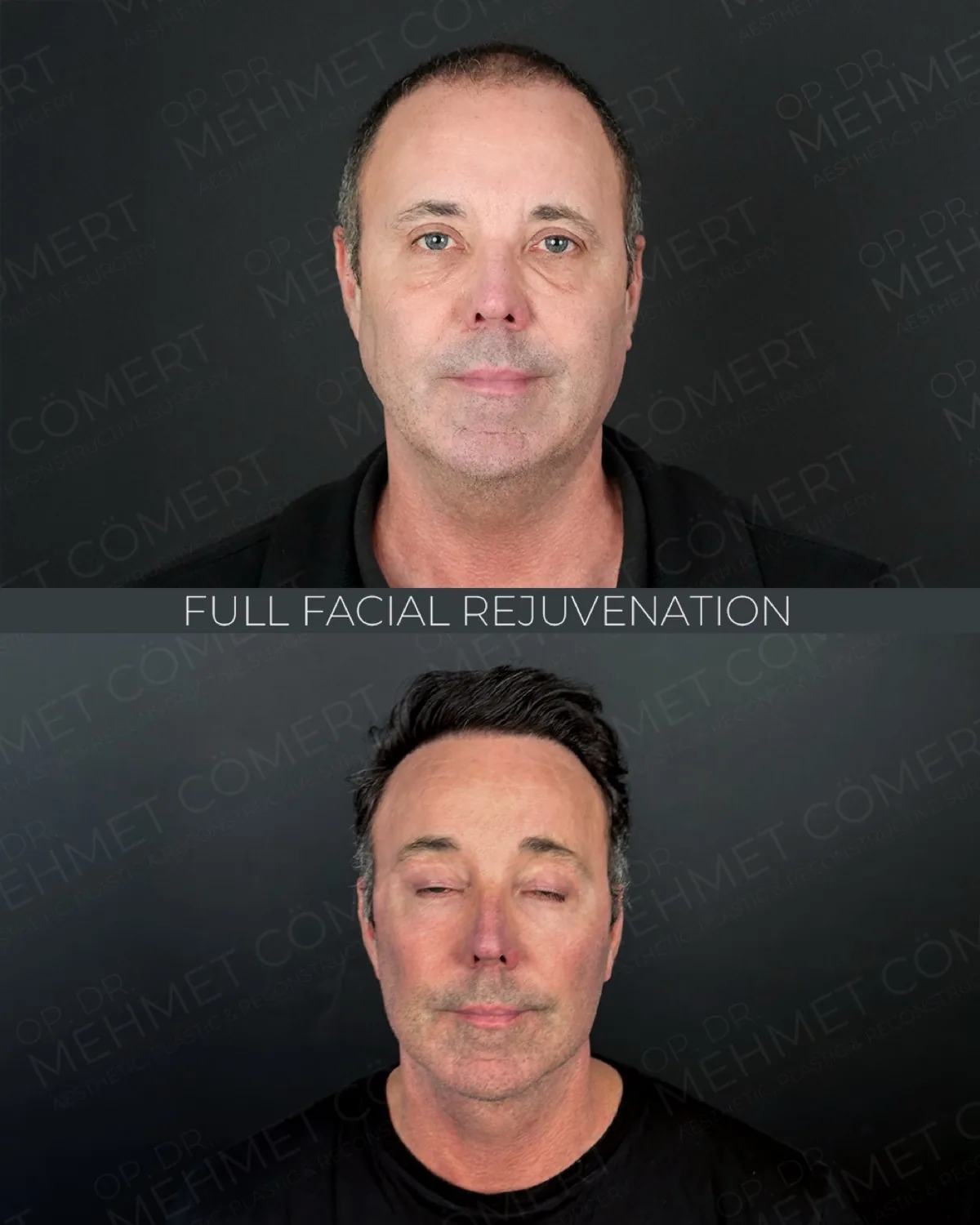 Deep Plane Facelift, before and after