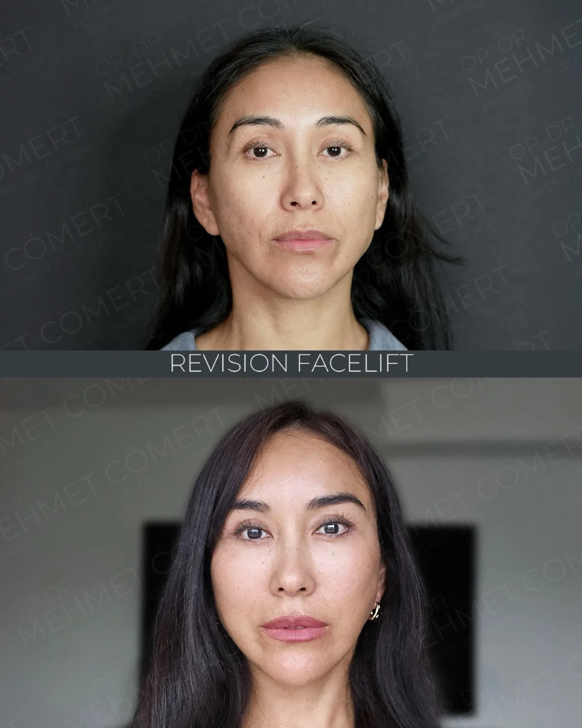 Revision Deep Plane Facelift, before and after