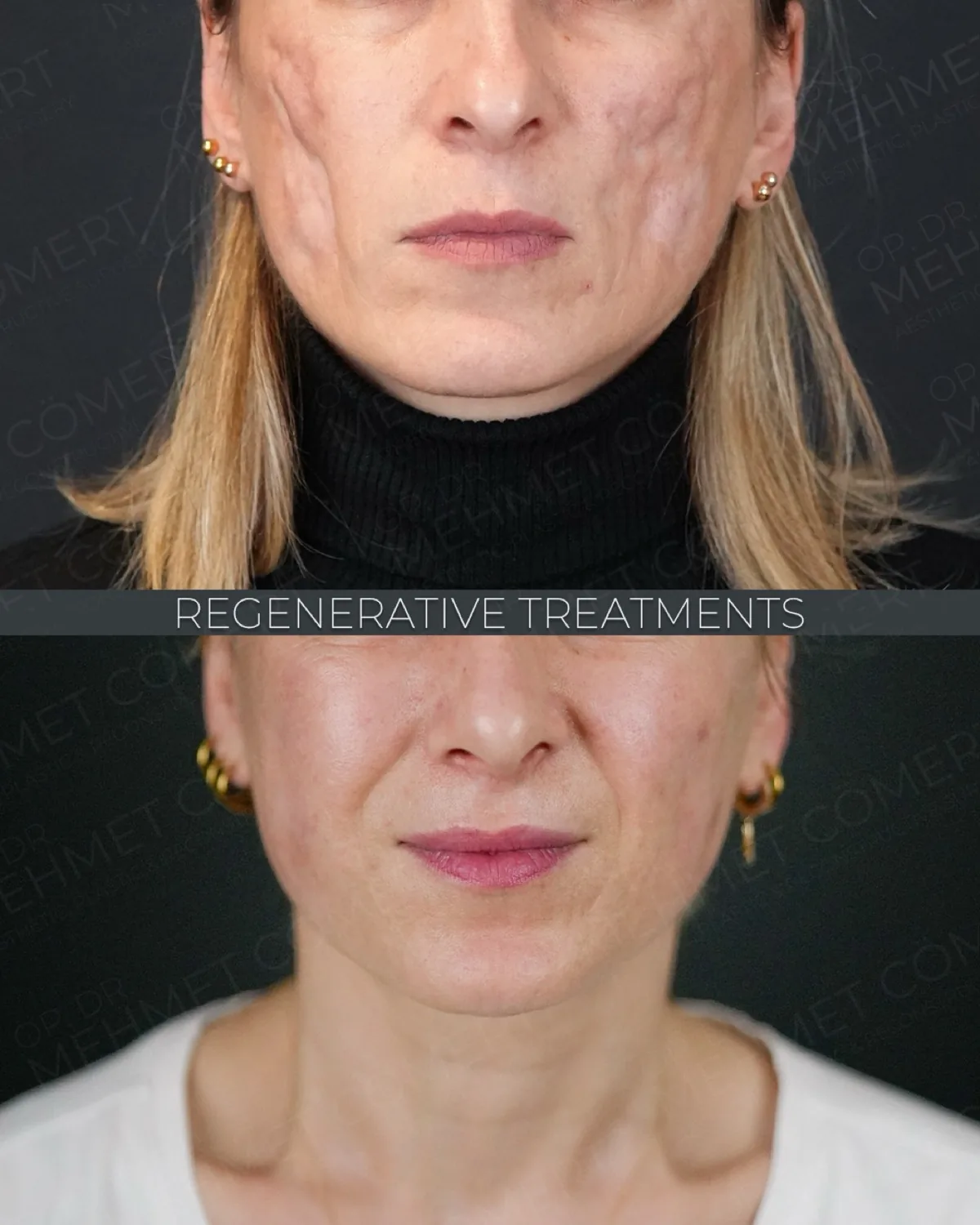 Fat, Nano-Fat & Micro-Fat Grafting, before and after