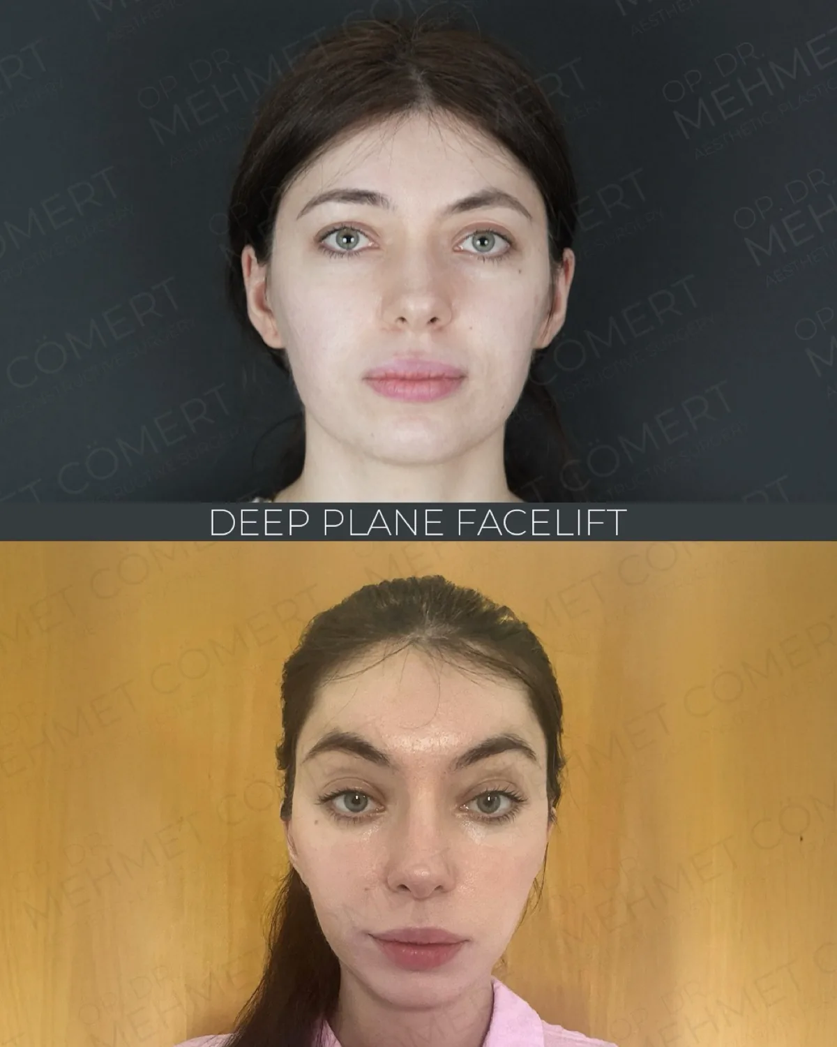 Deep Plane Facelift, before and after