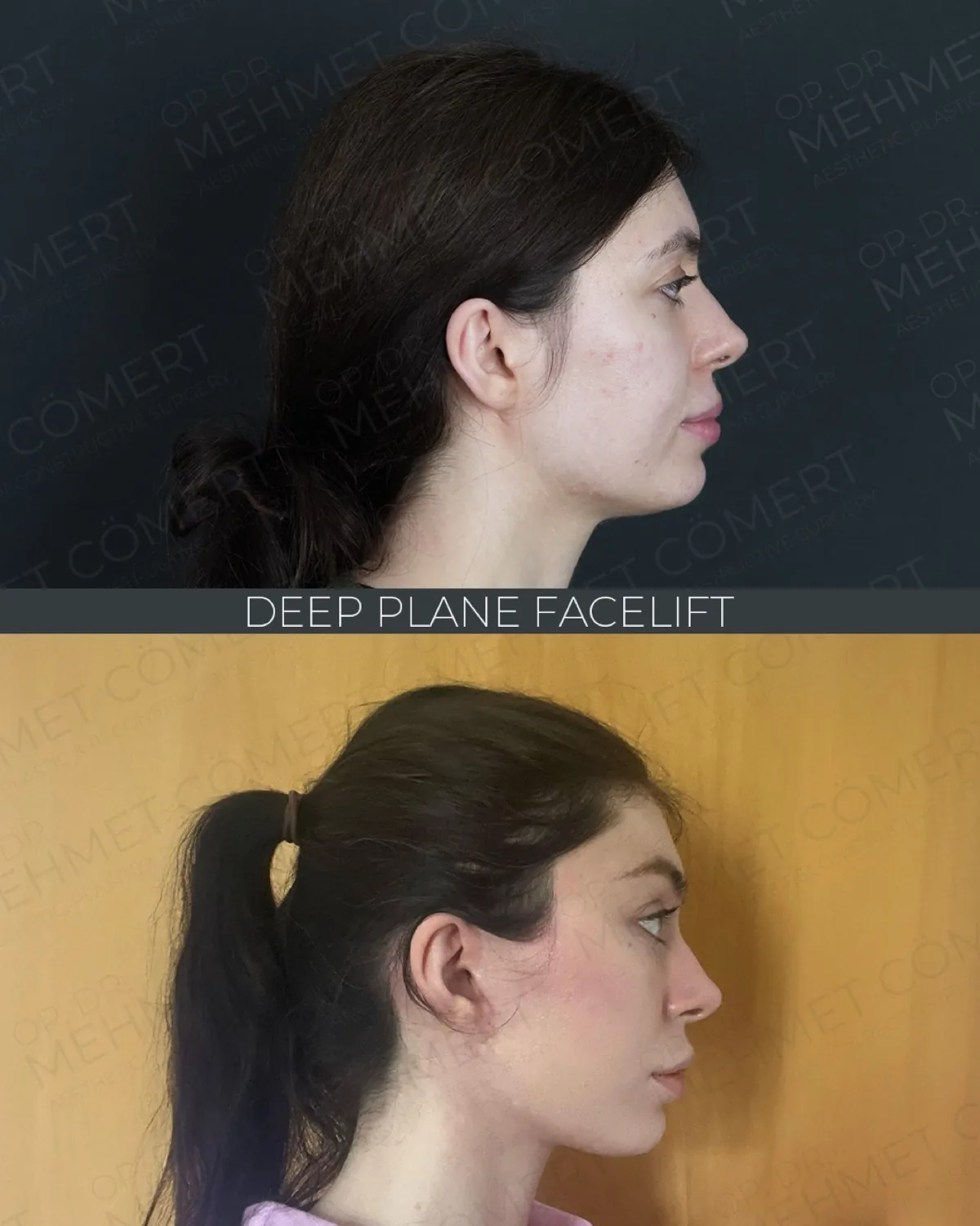 Before and after photographs of a 29 year old UK patient six months after a deep plane facelift combined with an endoscopic forehead lift, fat transfer, SVF and exosome treatment