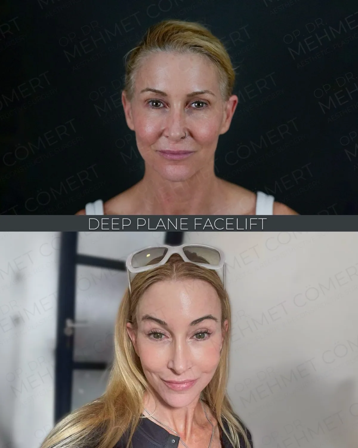 Deep Plane Facelift, before and after