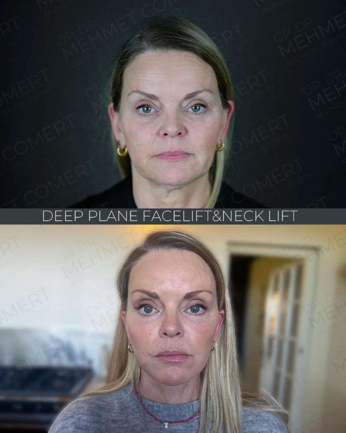 Deep Plane Facelift, before and after