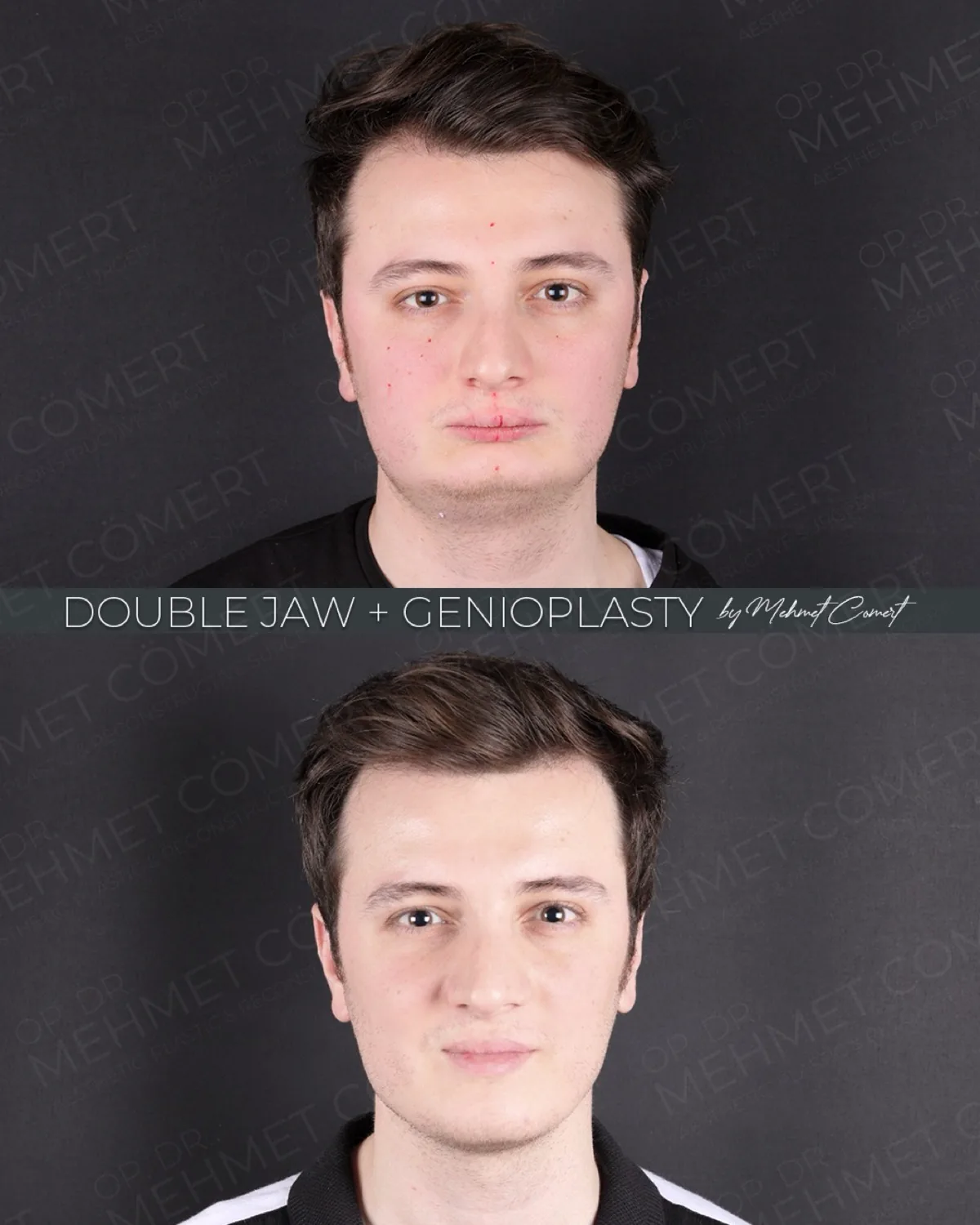 Double Jaw, before and after