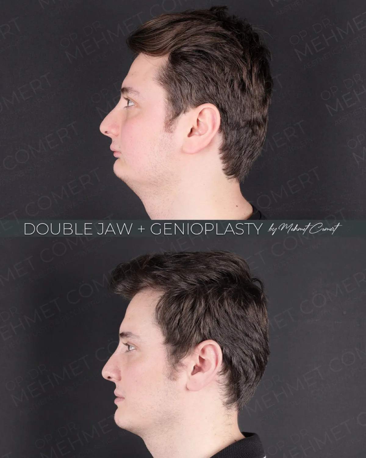 Orthognathic Surgery, double jaw before and after