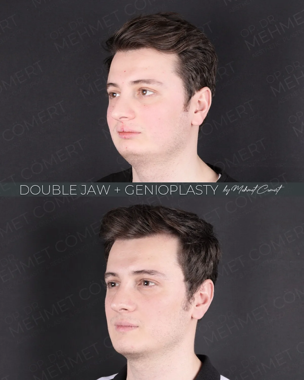 Three-quarter view before and after double jaw surgery with genioplasty in a 28-year-old patient at 1 month post-op