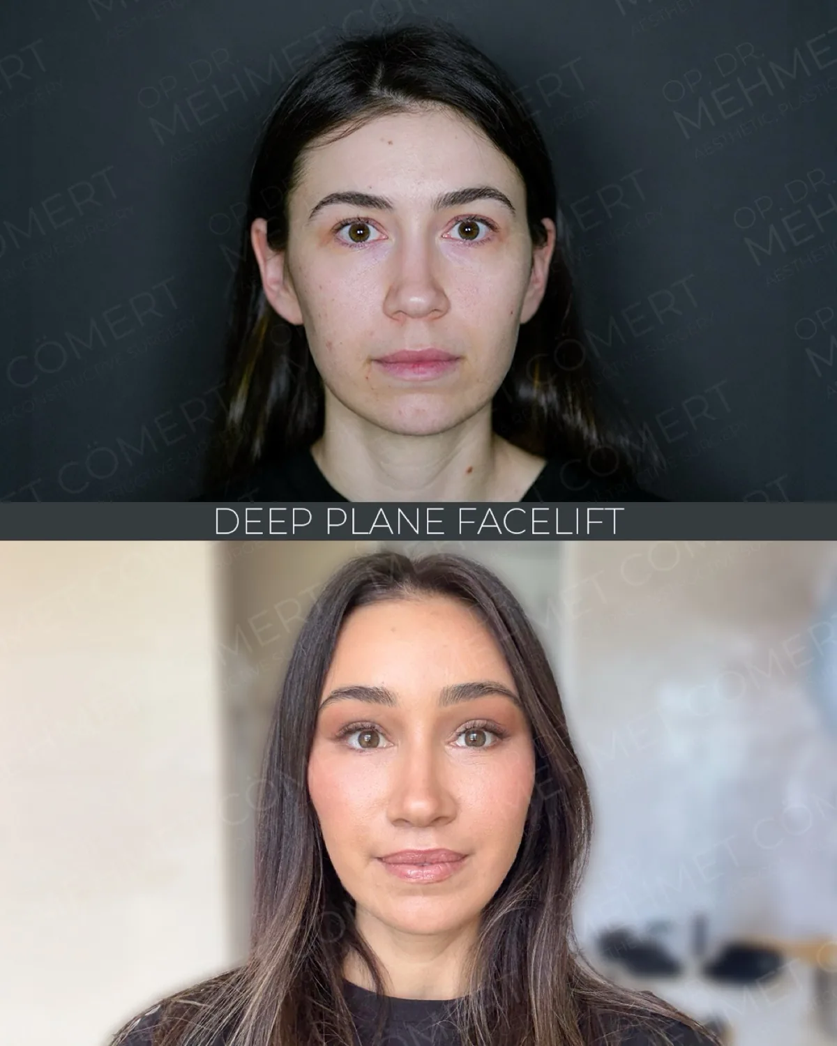 Endoscopic Facelift, before and after