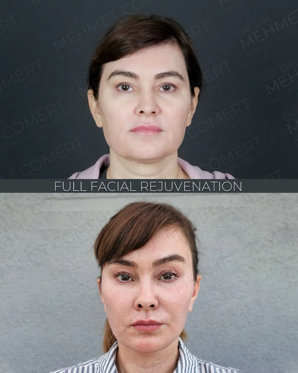 Deep Plane Facelift, before and after