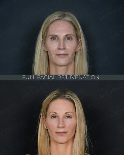 Deep Plane Facelift, before and after