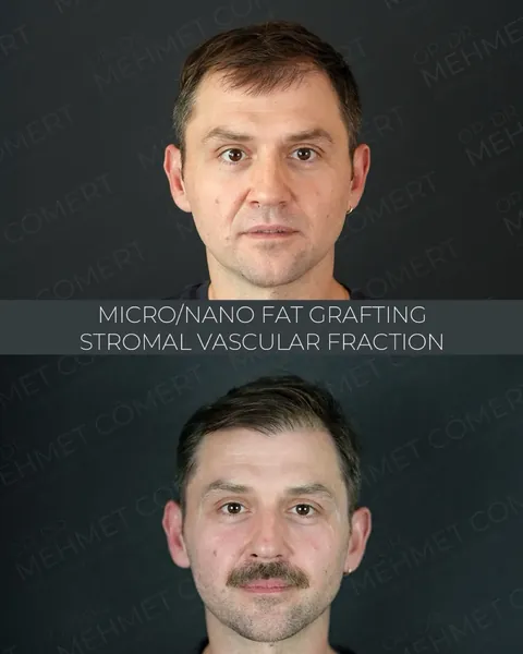 Fat, Nano-Fat & Micro-Fat Grafting, before and after
