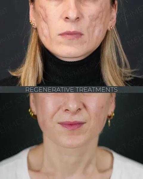 Fat, Nano-Fat & Micro-Fat Grafting, before and after