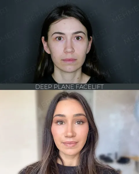 Endoscopic Facelift, before and after