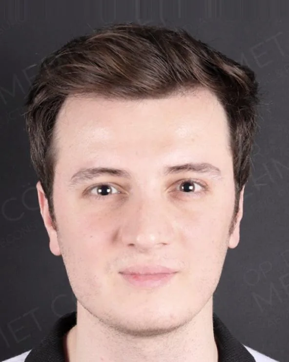 After, double jaw surgery with genioplasty