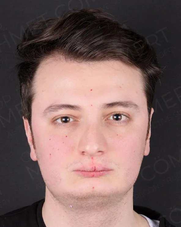 Before, double jaw surgery with genioplasty