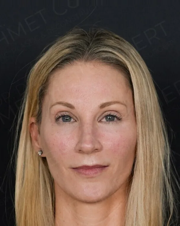 After, full facial rejuvenation