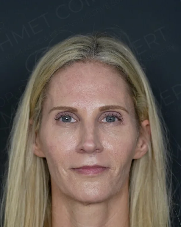 Before, full facial rejuvenation