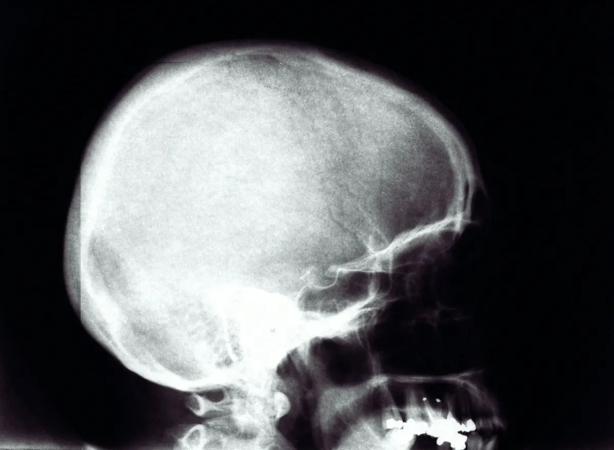 Lateral skull X-ray showing the profile of the skull, upper jaw and lower jaw