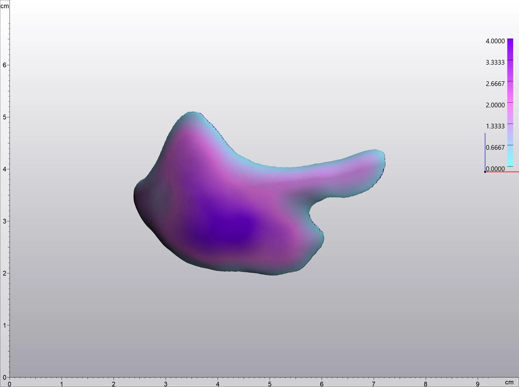 Thickness map of a patient-specific cheek and midface implant showing millimetre-level augmentation
