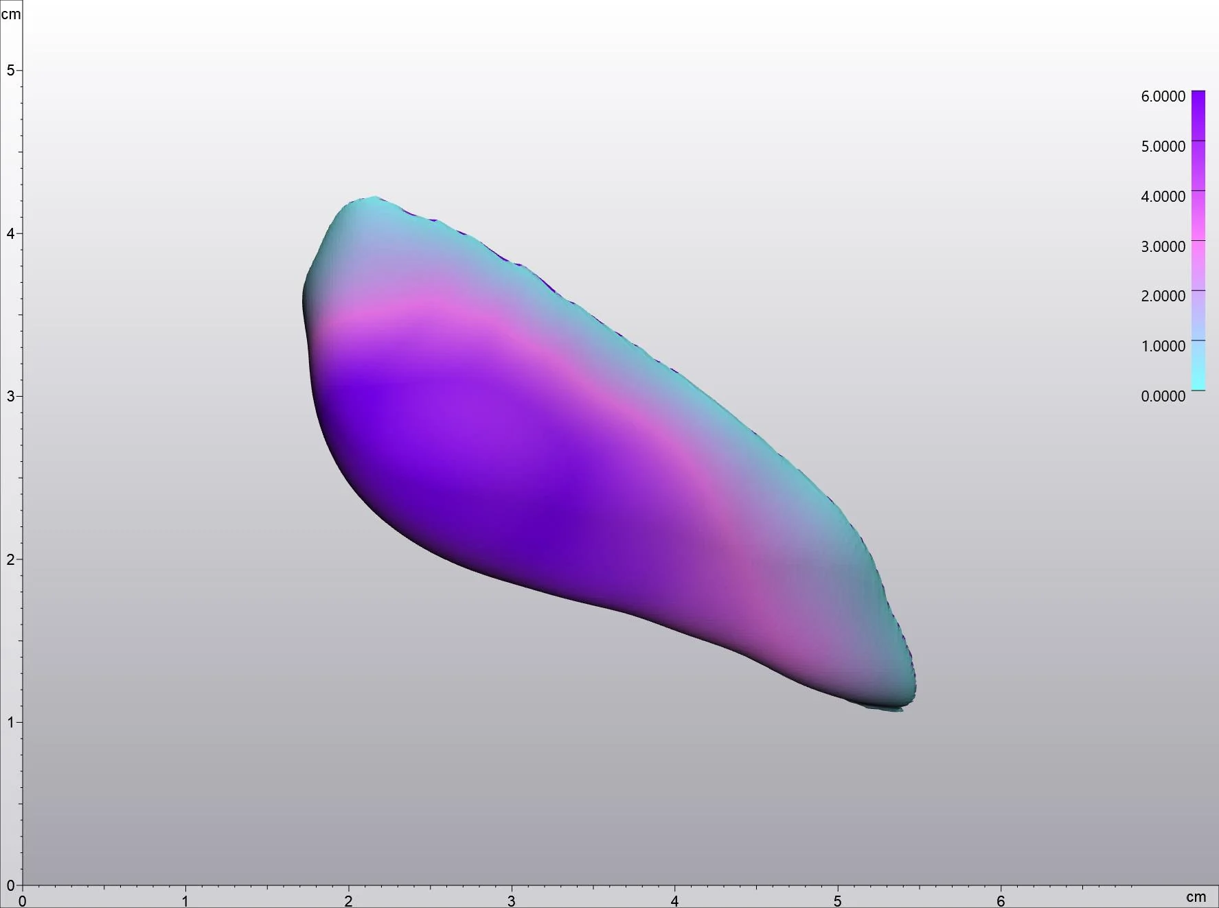 Thickness map of a patient-specific jaw angle implant, coloured by millimetres of augmentation