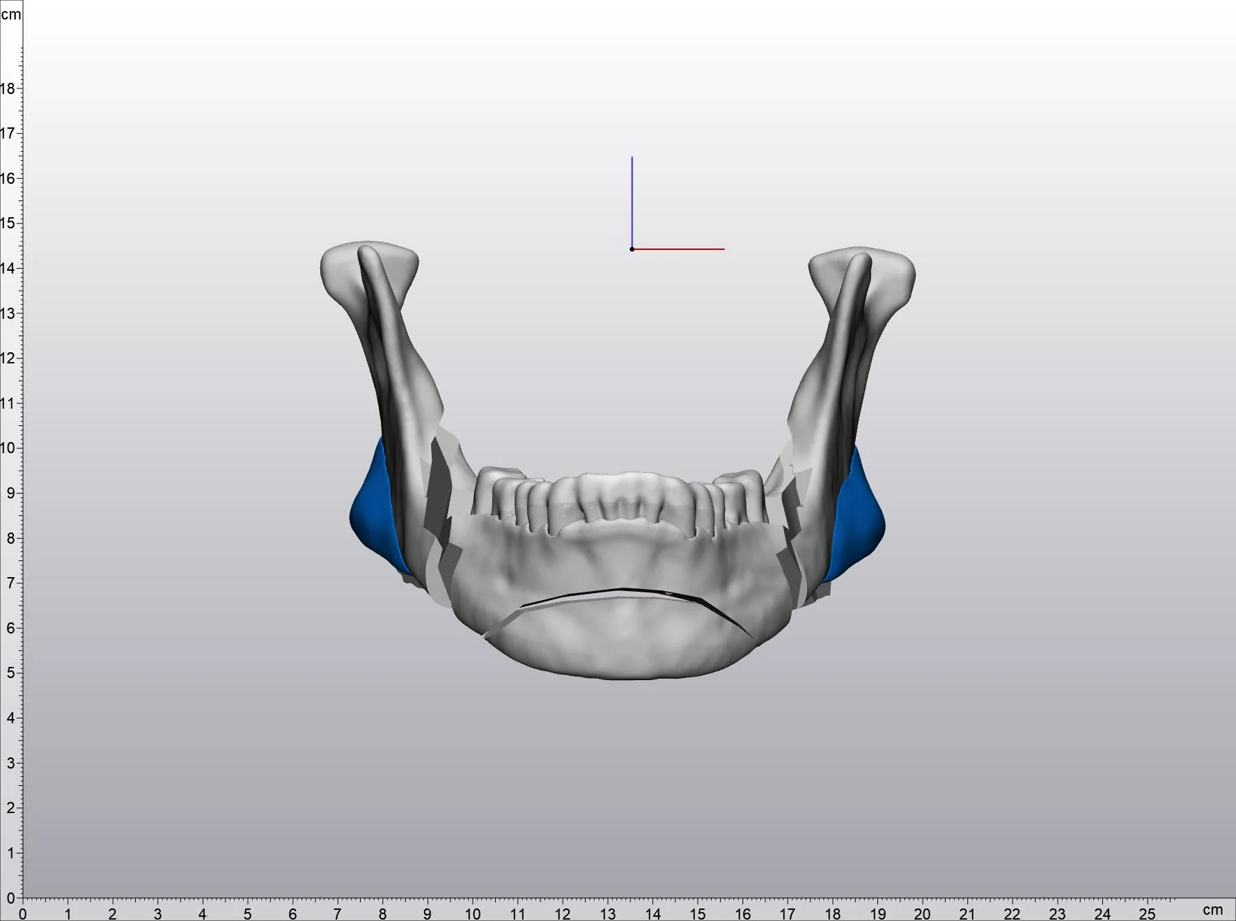 Planned patient-specific jaw angle implants shown in blue on a 3D mandible model, viewed from above