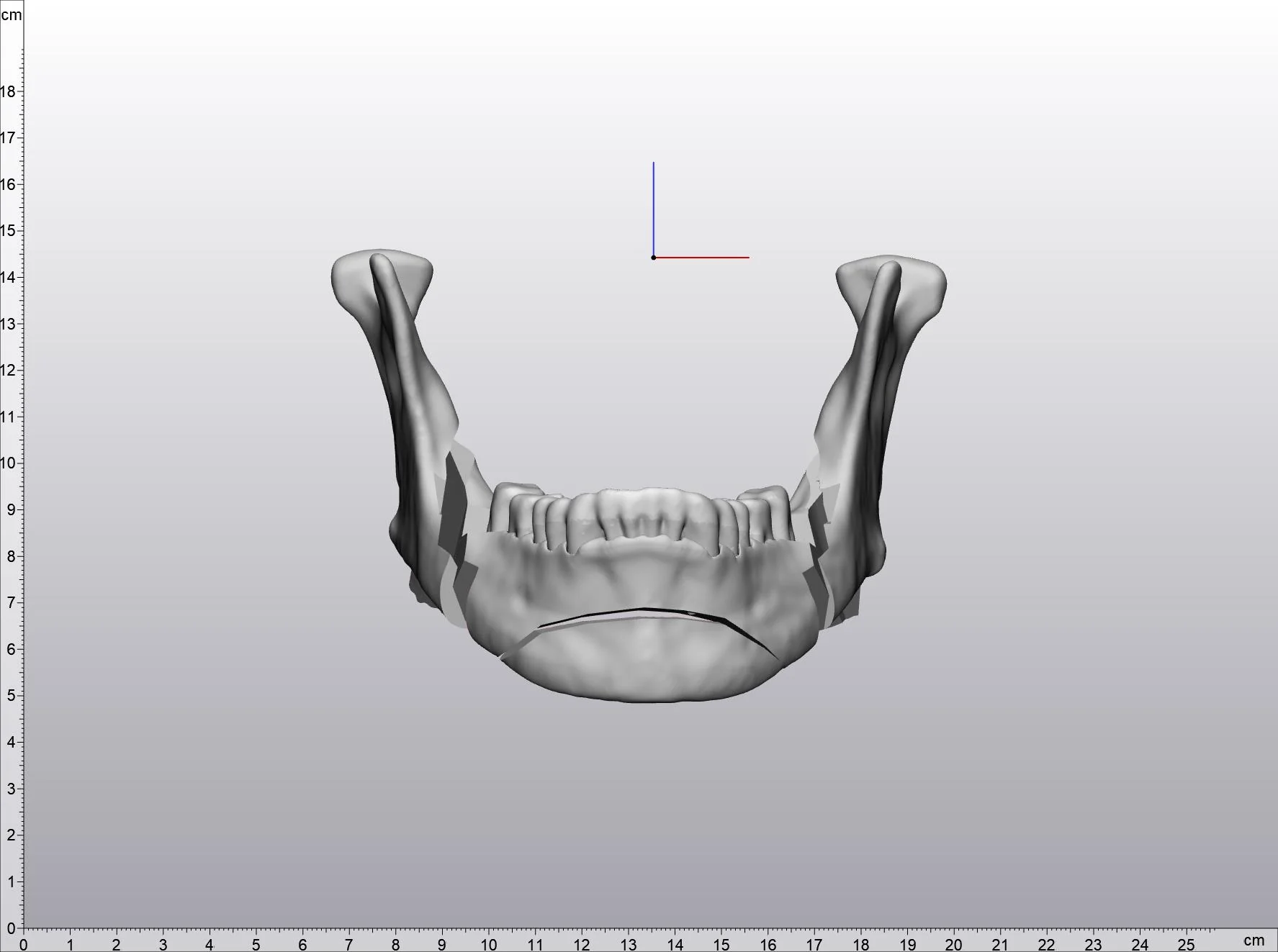 Preoperative mandible viewed from above, before implant planning