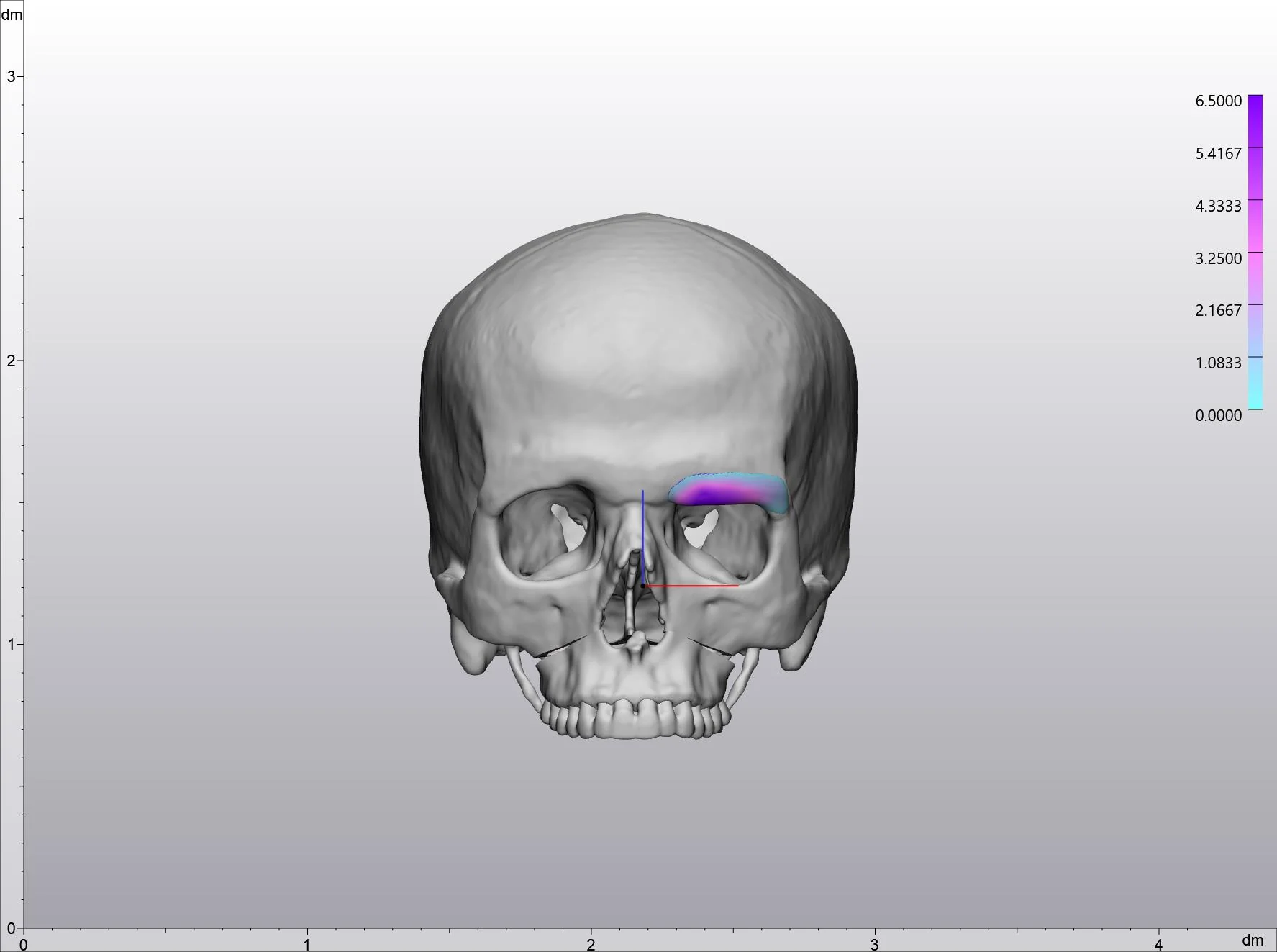 Patient-specific implant planned at the orbital rim on a 3D skull model