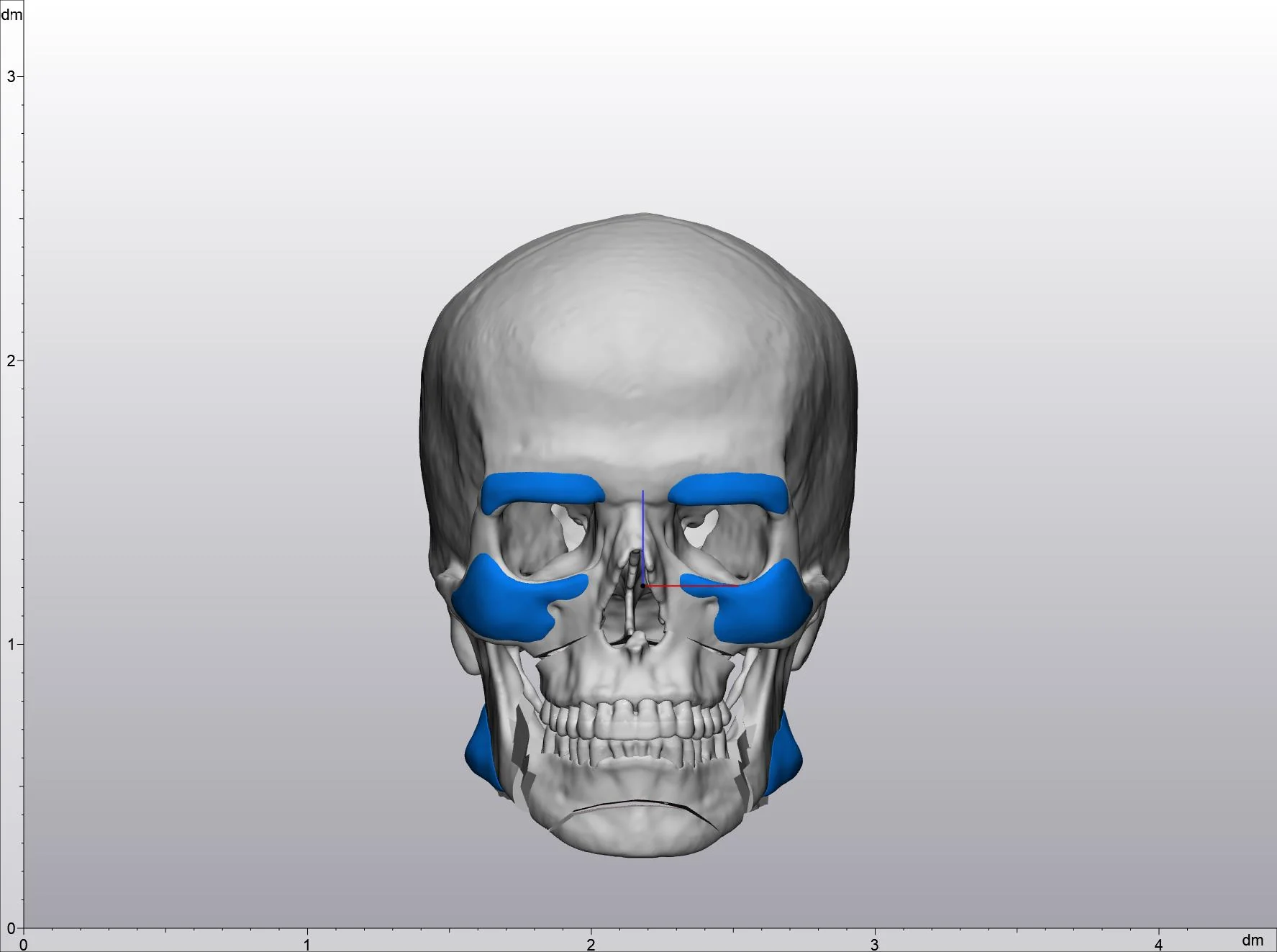 Patient-specific facial implants planned in 3D on a CT-derived skull: brow ridge, cheek and jaw angle implants shown in blue