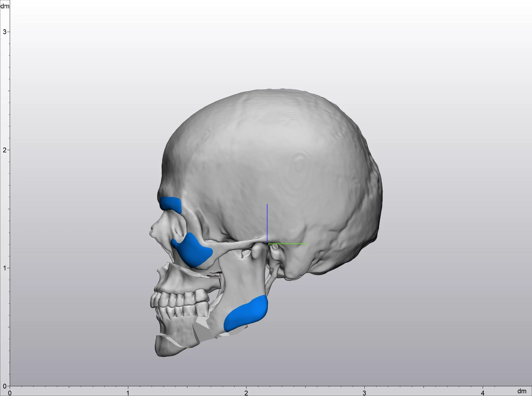 Oblique view of patient-specific brow, cheek and jaw implants designed on a 3D skull model