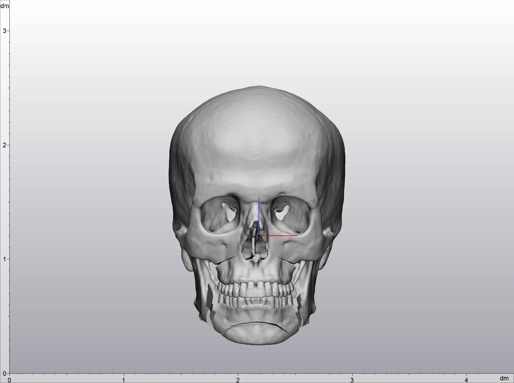 Preoperative 3D skull model reconstructed from a CT scan, before any implant design