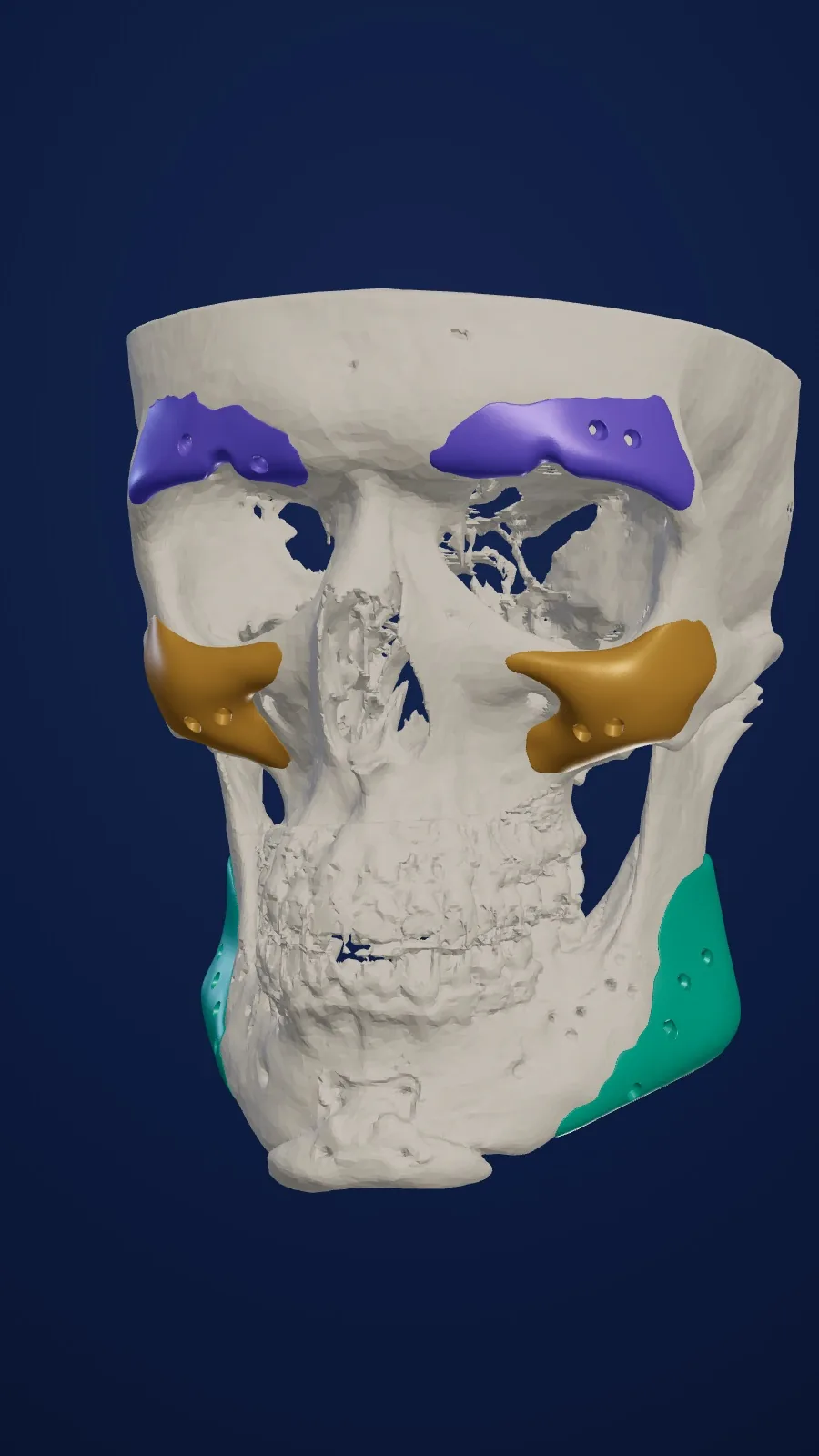 Patient-specific custom facial implants on a 3D skull model